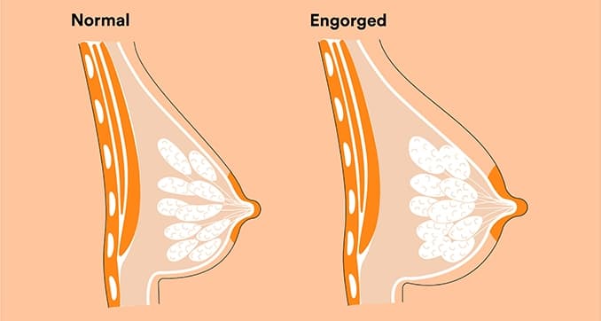 Breast Engorgement: Symptoms, Treatment, and More